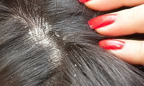 Tips to Get Dandruff – Free and Silky Hairs – EzHome Blog